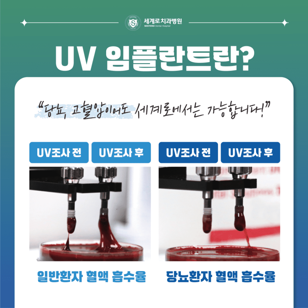 부산 보험 임플란트 UV 임플란트로 치료하세요