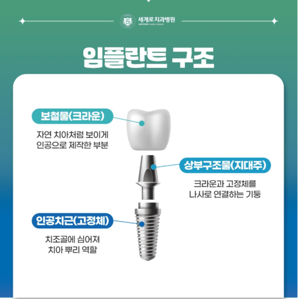 임플란트의 구조