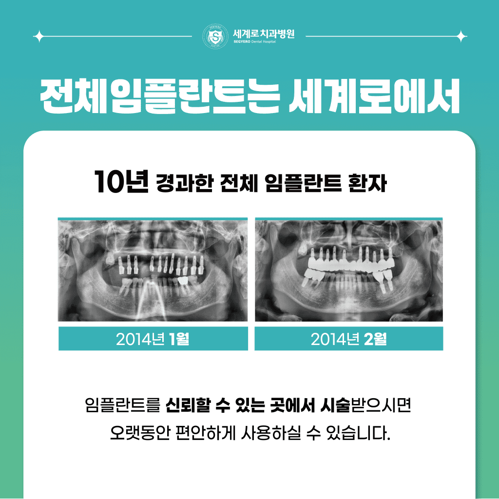 부산전체임플란트치료 세계로치과병원