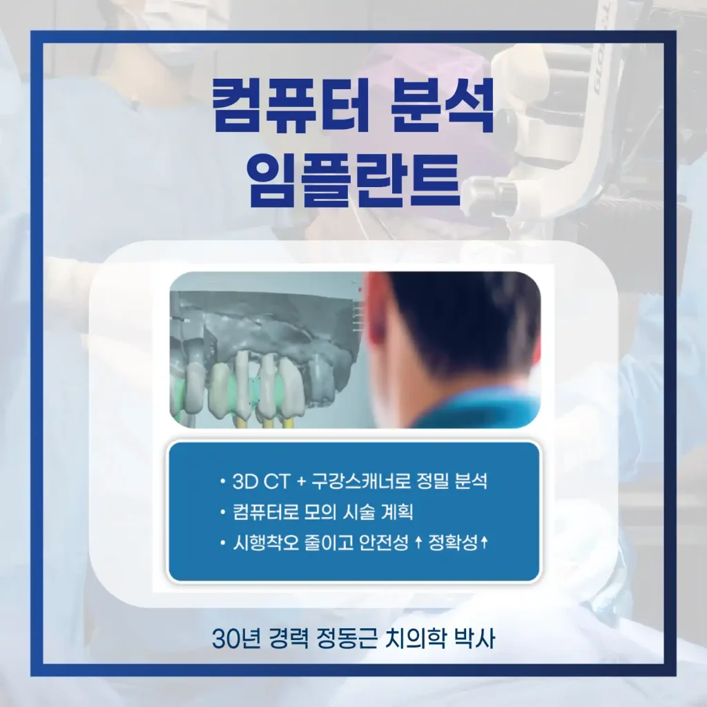 재송동임플란트 컴퓨터 분석 임플란트