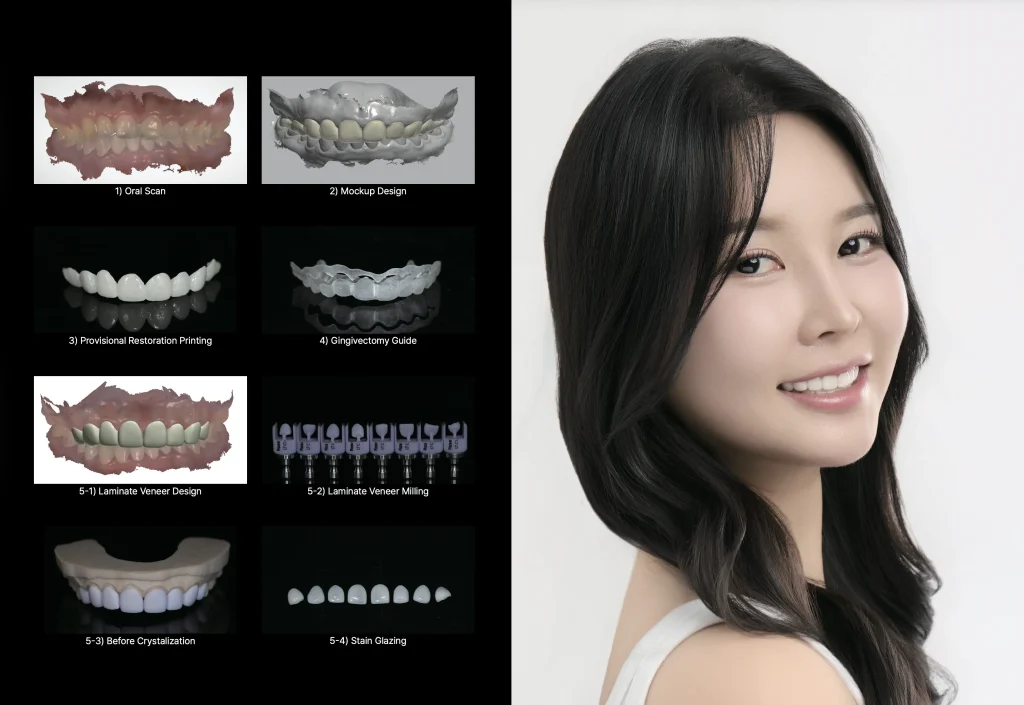 부산라미네이트 치아 삭제량 최소