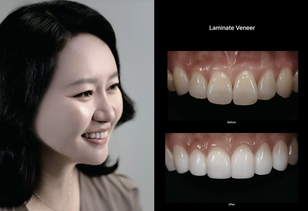 부산라미네이트 앞니 라미네이트
