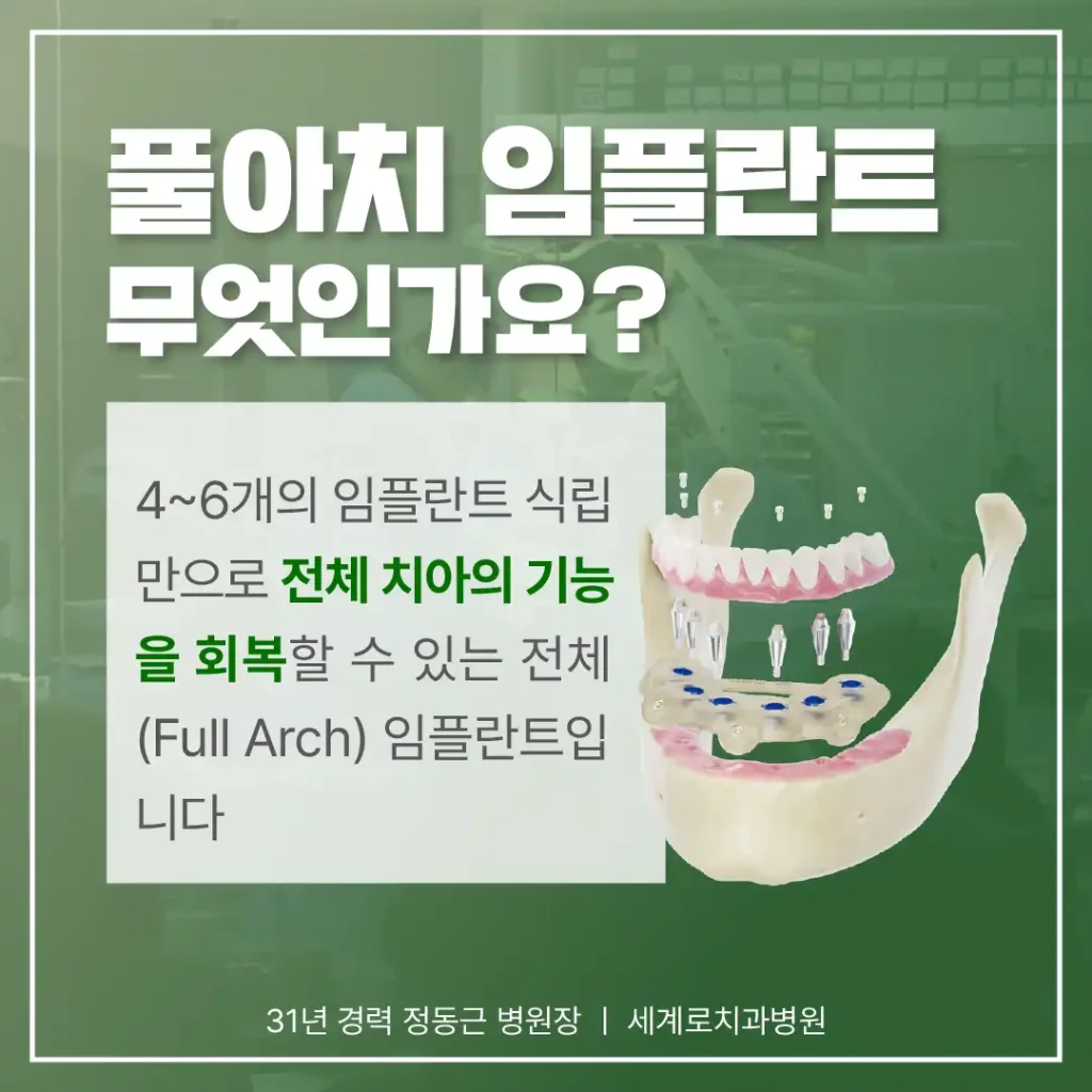 거창치과 에서 고난도 임플란트를 안전하게 하기 위한 방법