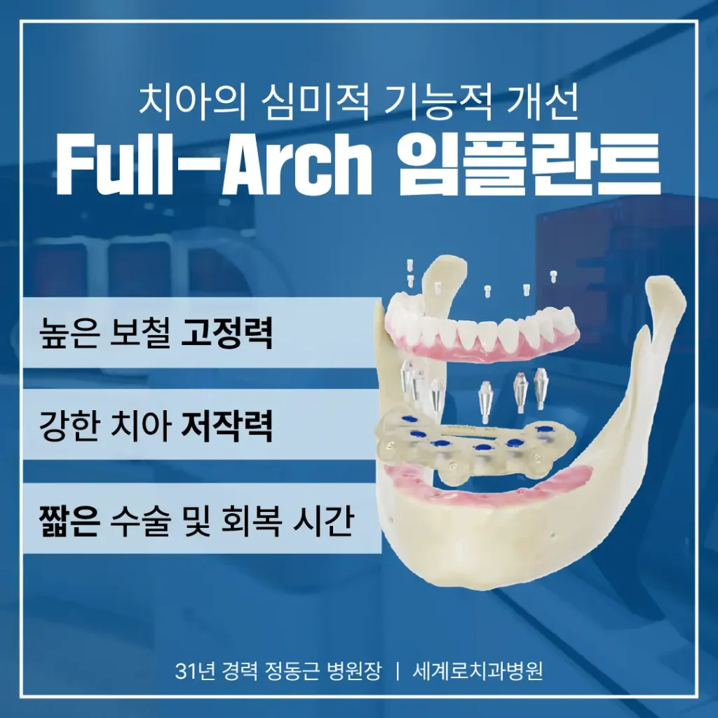임플란트의 수가(의료비용)은 어느 정도