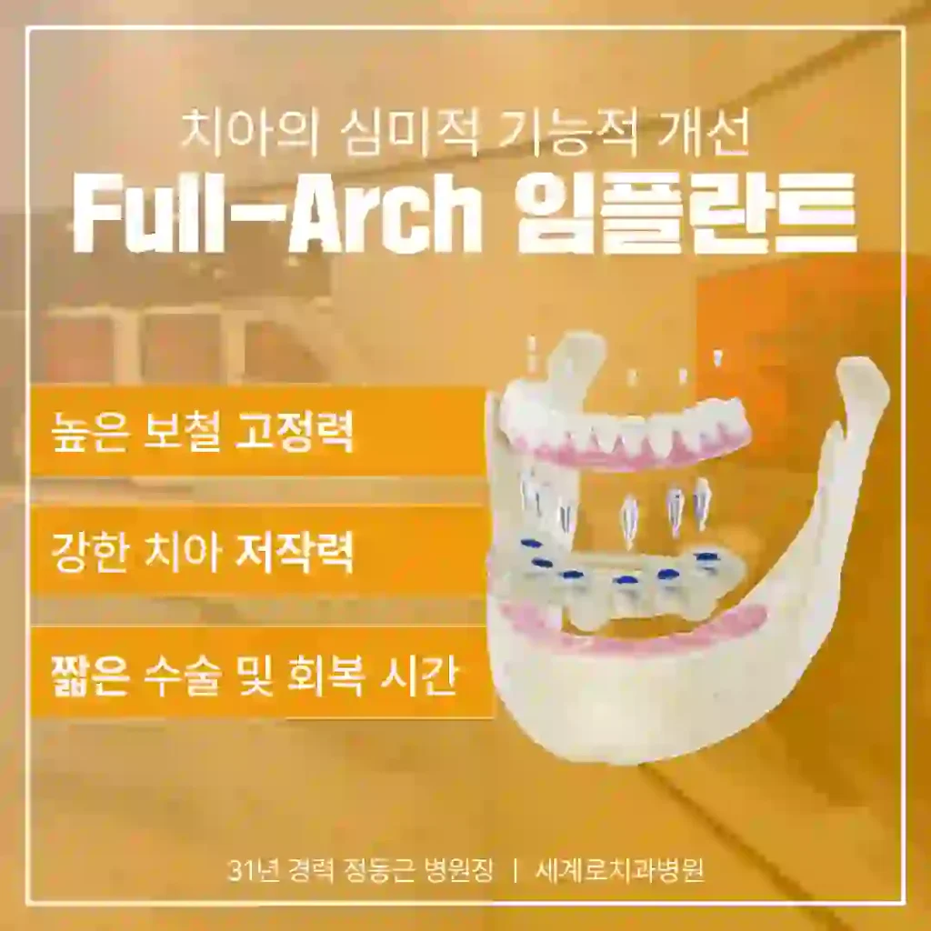 풀아치임플란트는 왜 주목받고 있을까요?