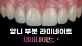 부산 앞니 부분 라미네이트, 컴퓨터 분석으로