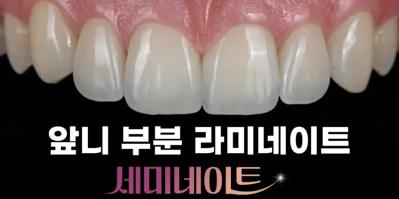 부산 앞니 부분 라미네이트, 컴퓨터 분석으로