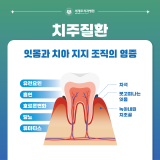 치주질환의 원인 방치하지 말아야할 이유