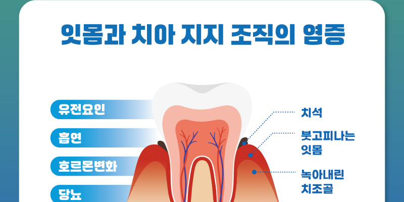 치주질환의 원인 방치하지 말아야할 이유