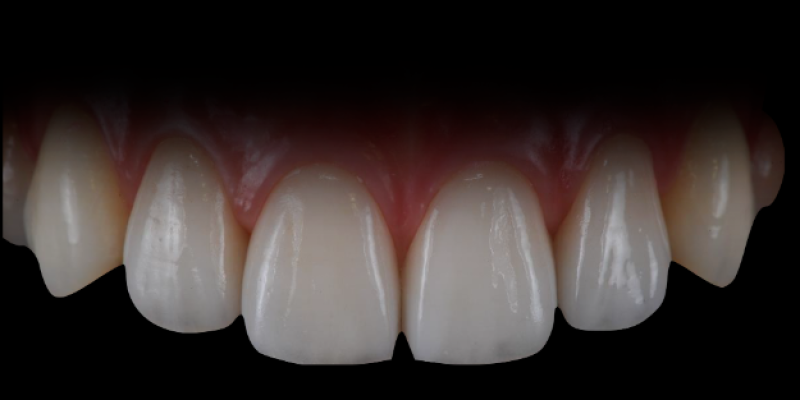 부산 크라운 치료 신속하게 하려면